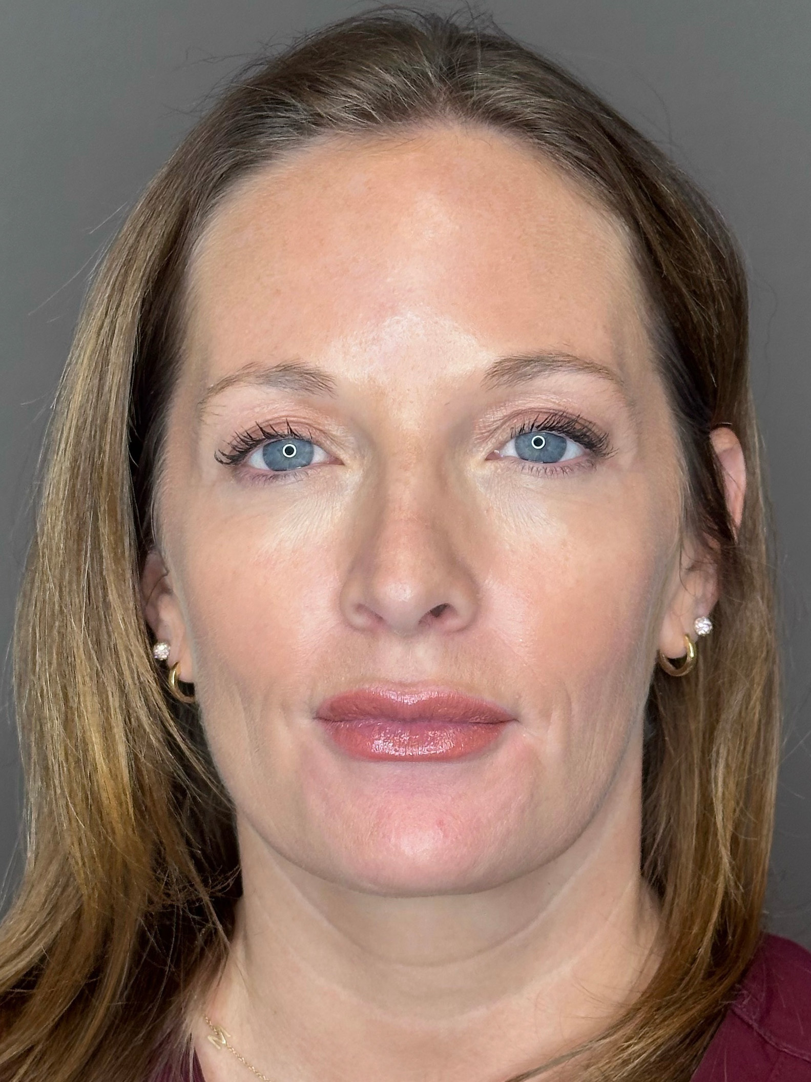 Microneedling with SkinPen Before & After Gallery - Patient 167838 - Image 2