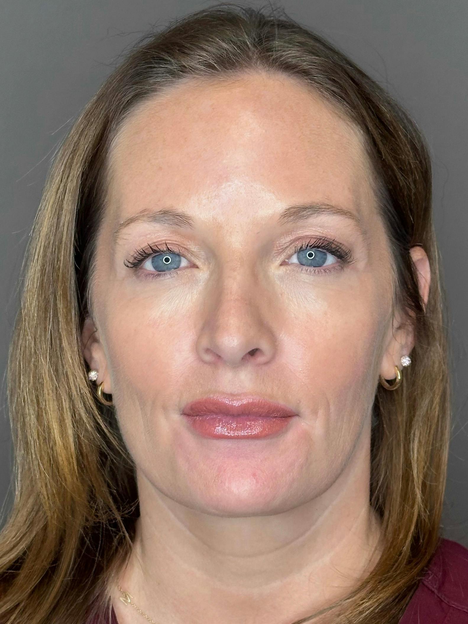 Microneedling with SkinPen Before & After Gallery - Patient 167838 - Image 2