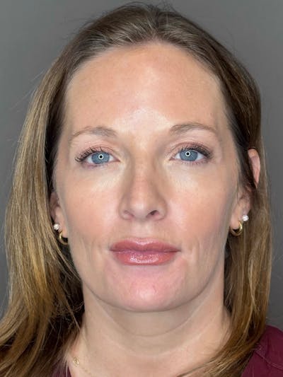 Microneedling with SkinPen Before & After Gallery - Patient 167838 - Image 2
