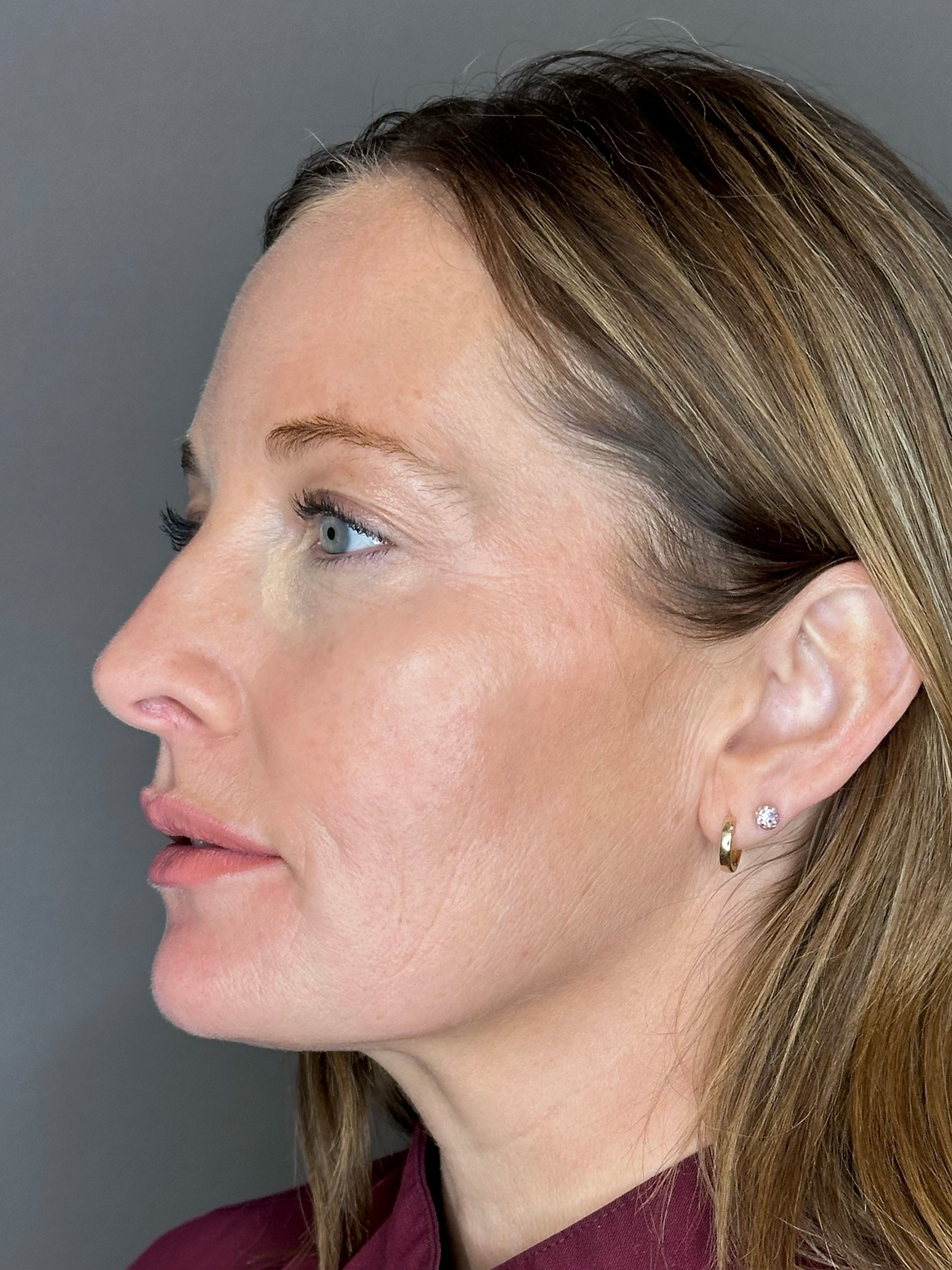 Microneedling with SkinPen Before & After Gallery - Patient 167838 - Image 6