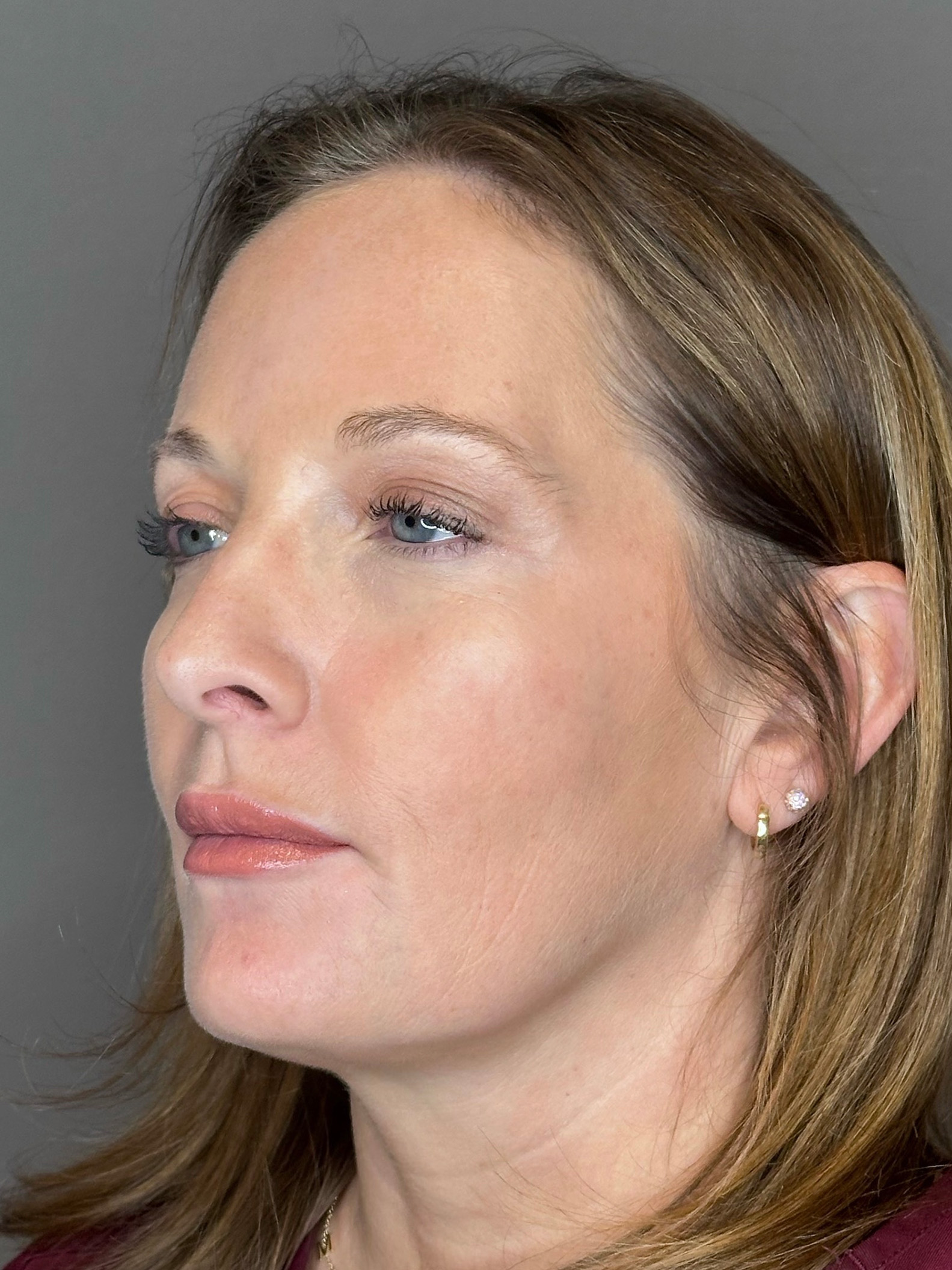 Microneedling with SkinPen Before & After Gallery - Patient 167838 - Image 5