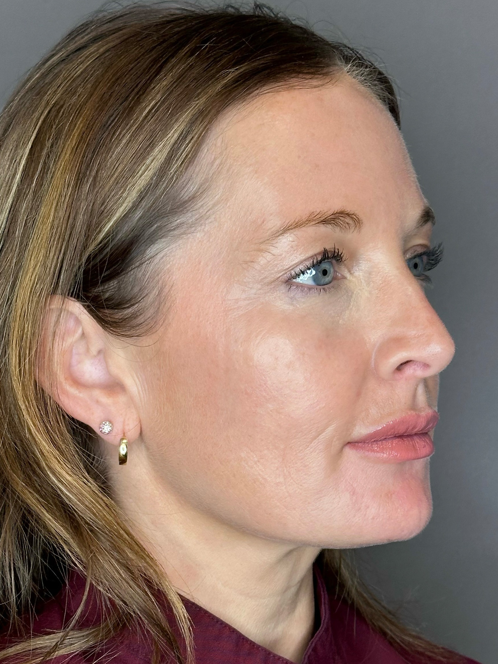 Microneedling with SkinPen Before & After Gallery - Patient 167838 - Image 3