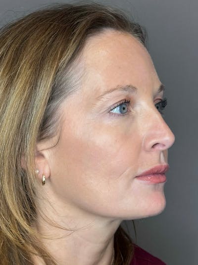 Microneedling with SkinPen Before & After Gallery - Patient 167838 - Image 4