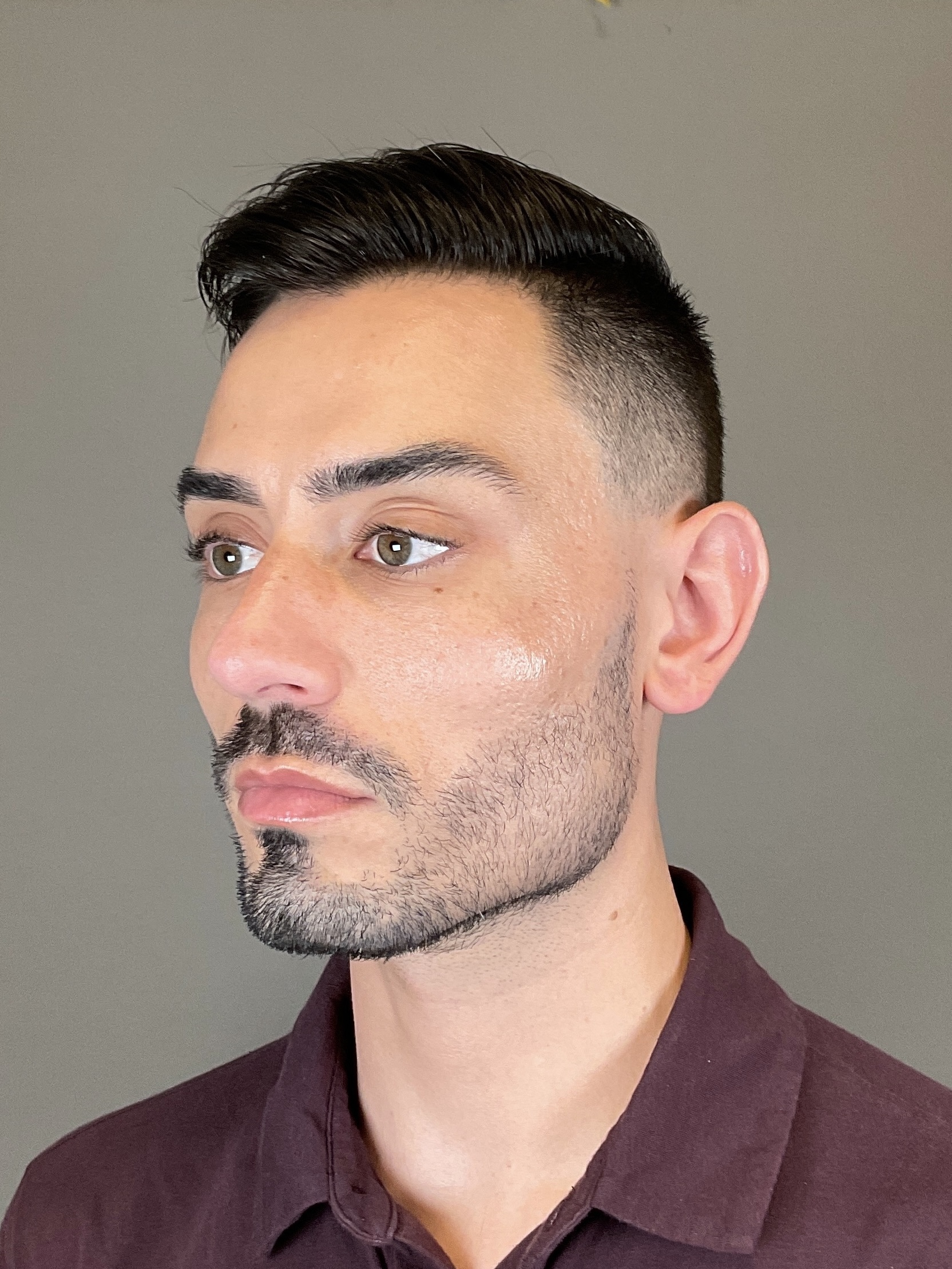 Sculptra Before & After Gallery - Patient 320418 - Image 5