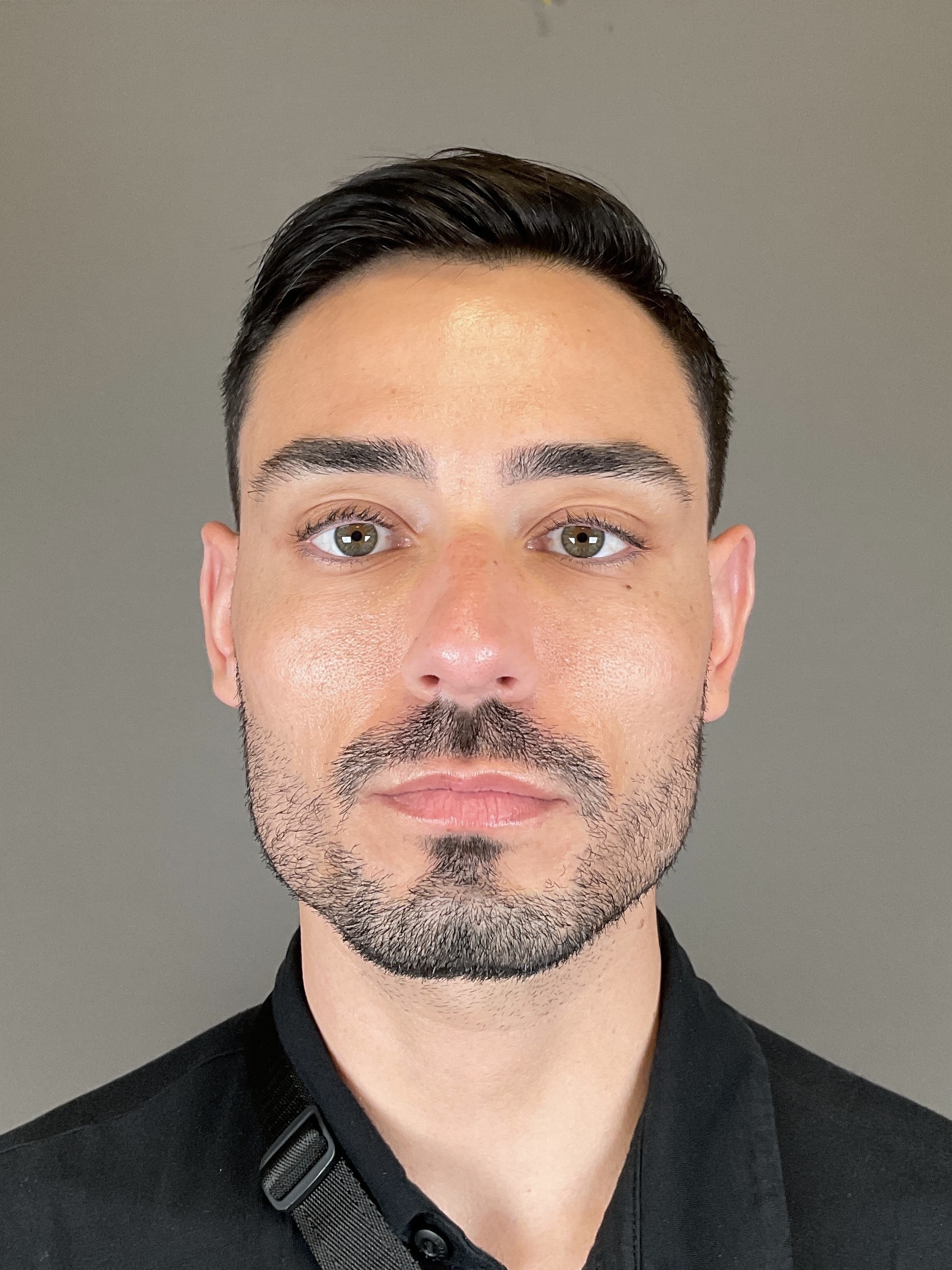 Sculptra Before & After Gallery - Patient 320418 - Image 2