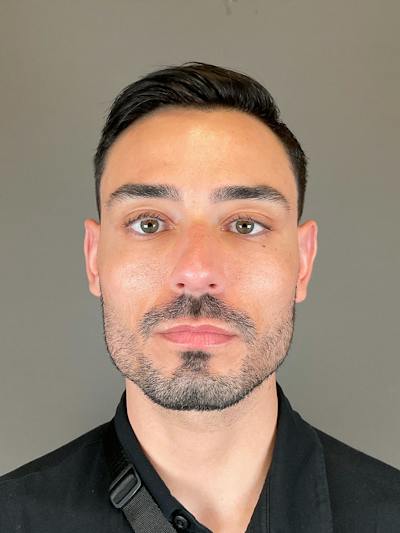 Sculptra Before & After Gallery - Patient 320418 - Image 2