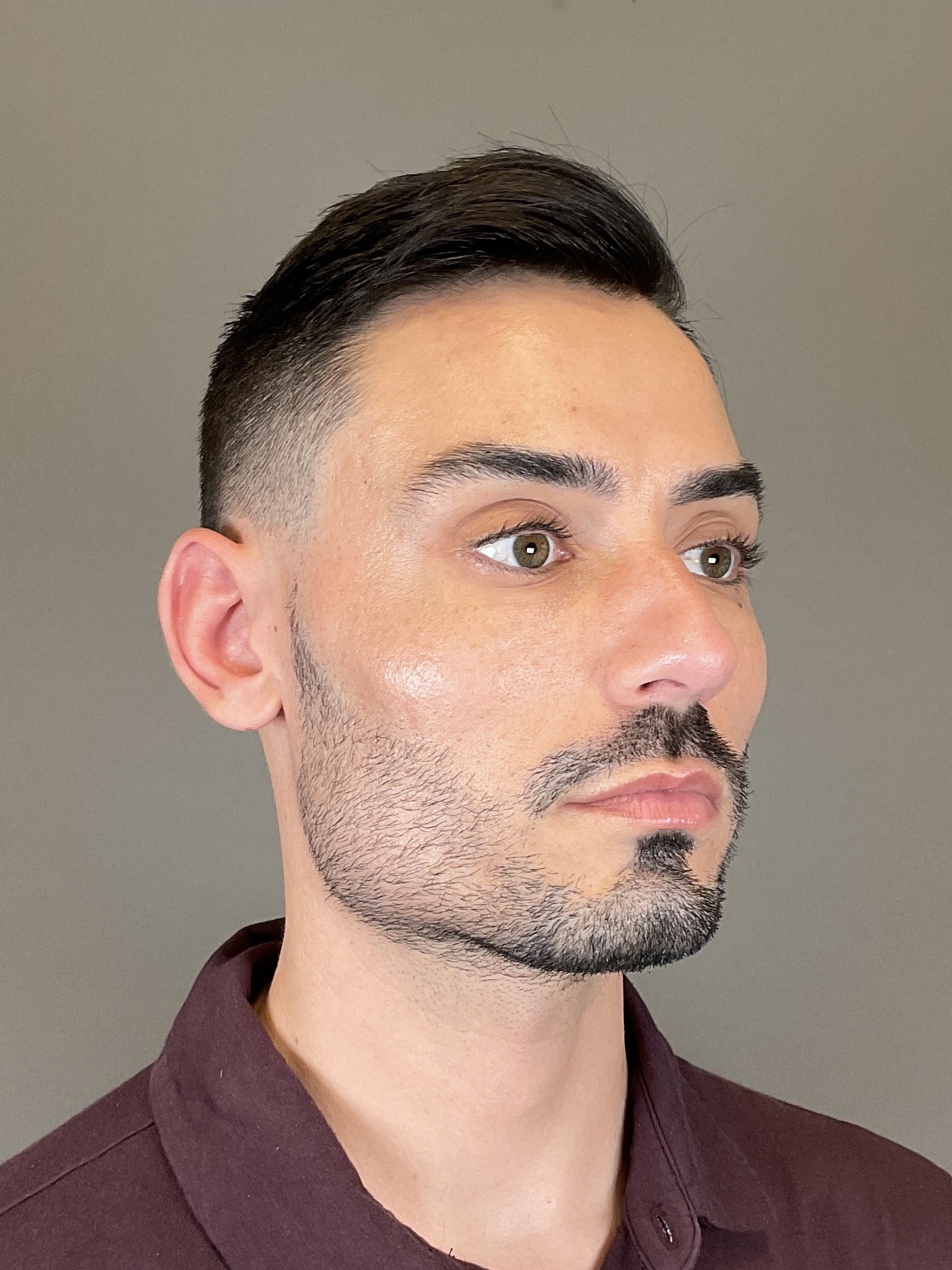 Sculptra Before & After Gallery - Patient 320418 - Image 3