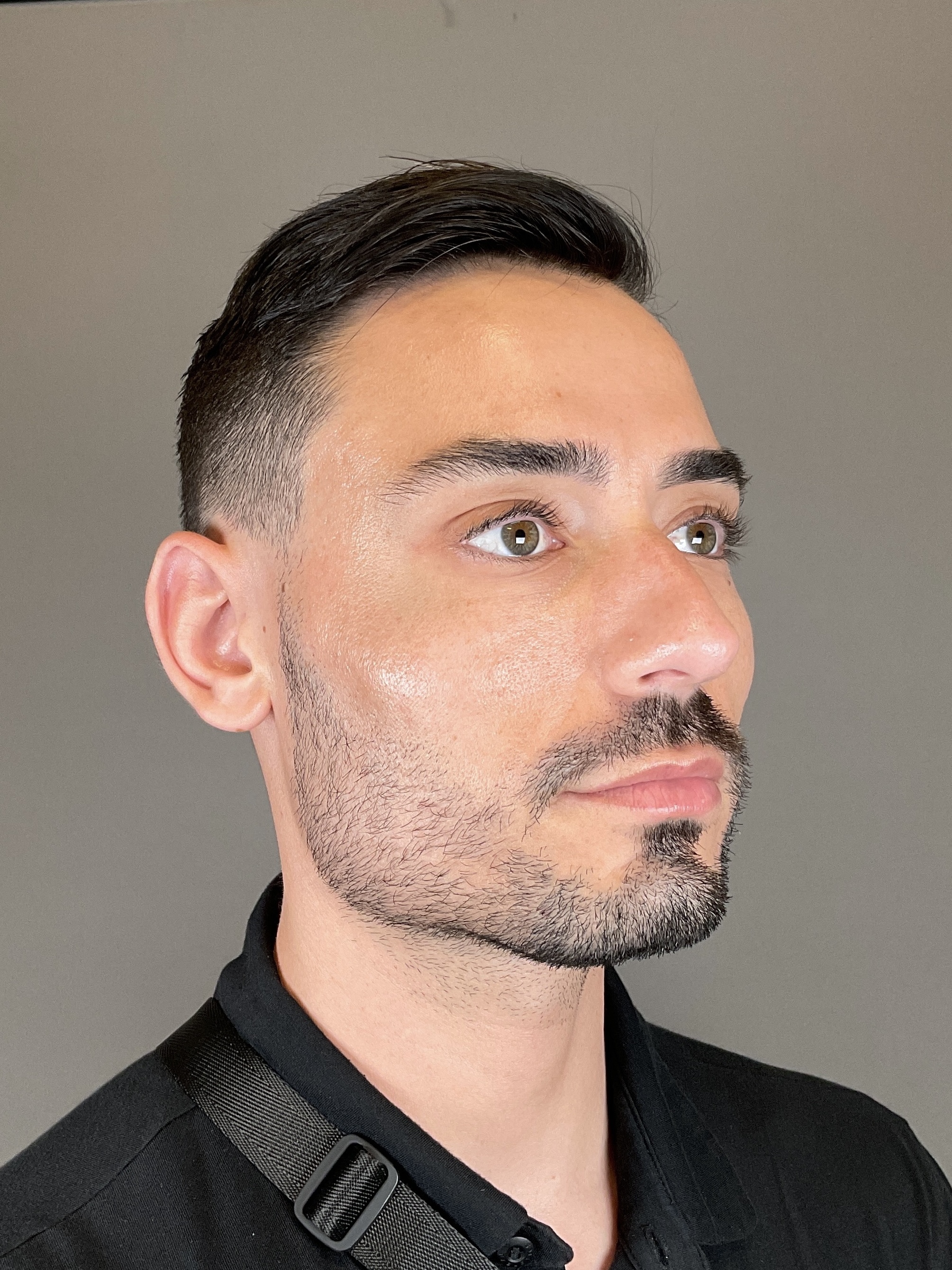 Sculptra Before & After Gallery - Patient 320418 - Image 4