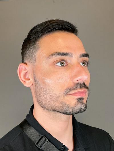 Sculptra Before & After Gallery - Patient 320418 - Image 4