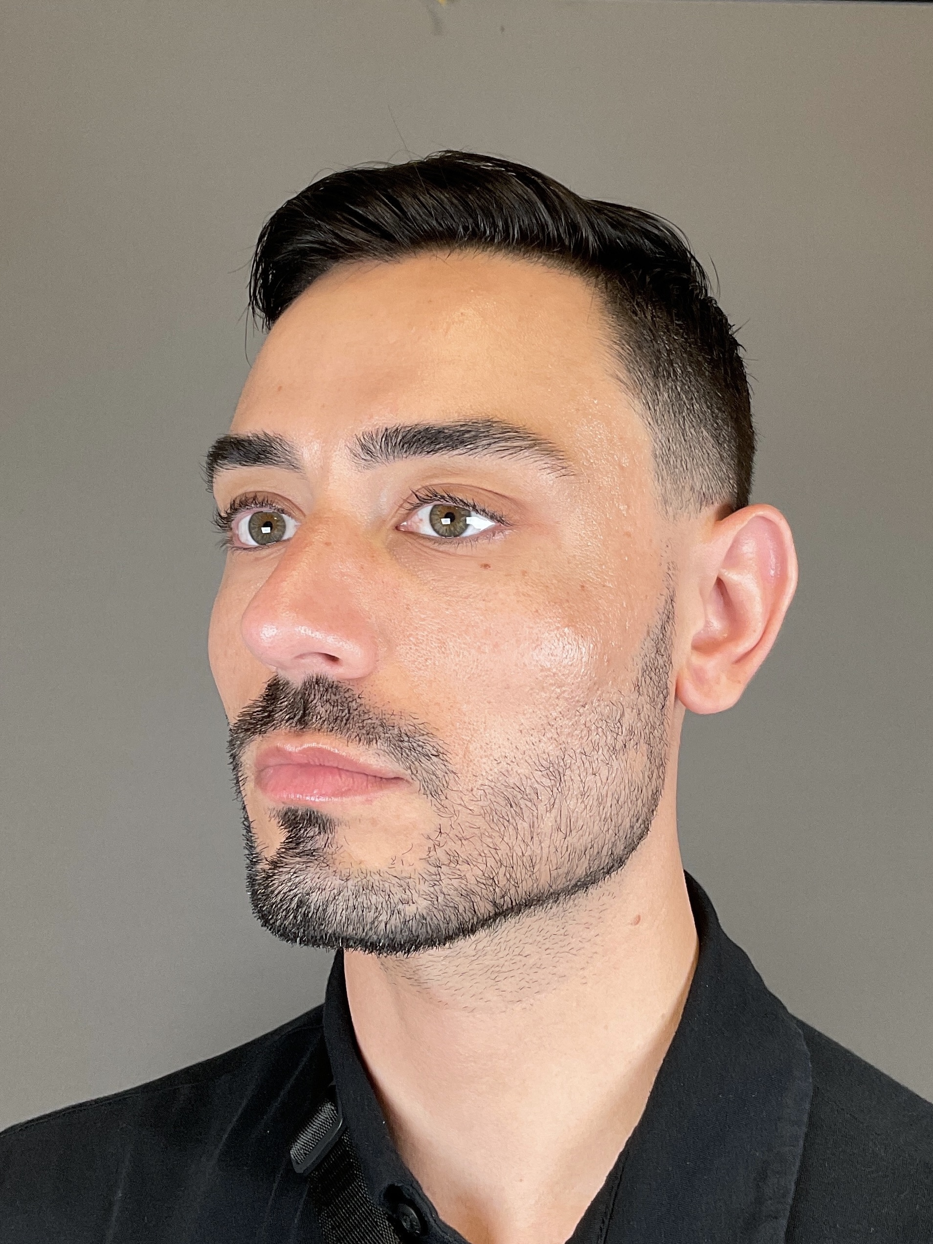 Sculptra Before & After Gallery - Patient 320418 - Image 6