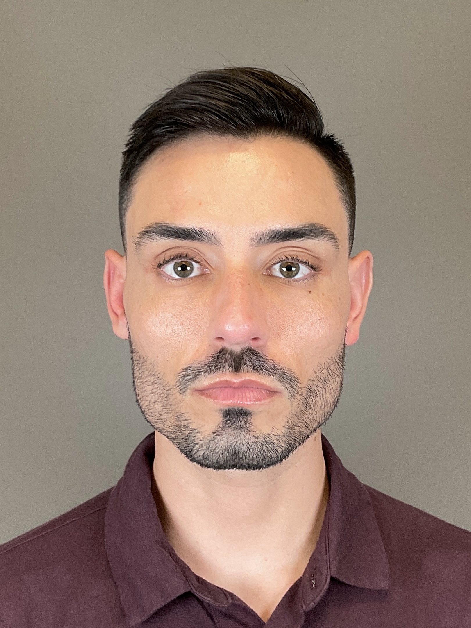 Sculptra Before & After Gallery - Patient 320418 - Image 1