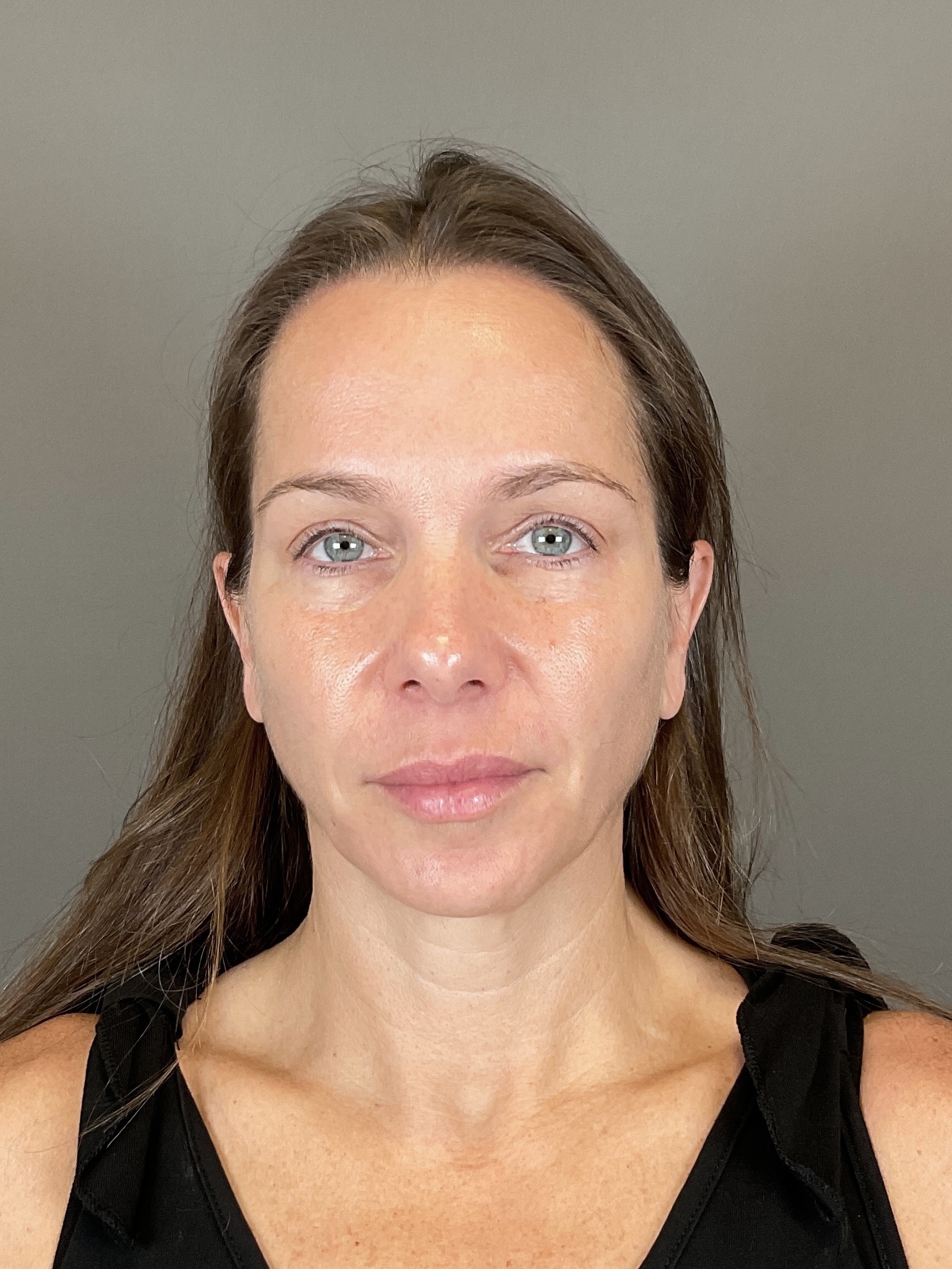 Sculptra Before & After Gallery - Patient 143308 - Image 2