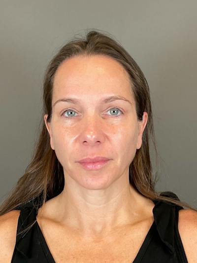 Sculptra Before & After Gallery - Patient 143308 - Image 2