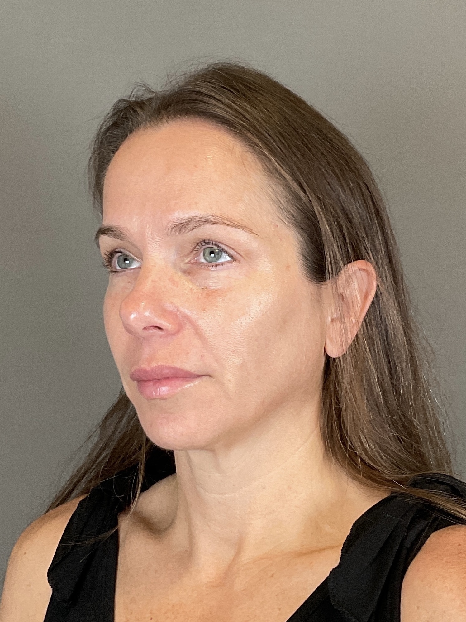 Sculptra Before & After Gallery - Patient 143308 - Image 6