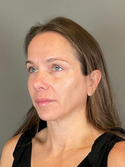 Sculptra Before & After Gallery - Patient 143308 - Image 6