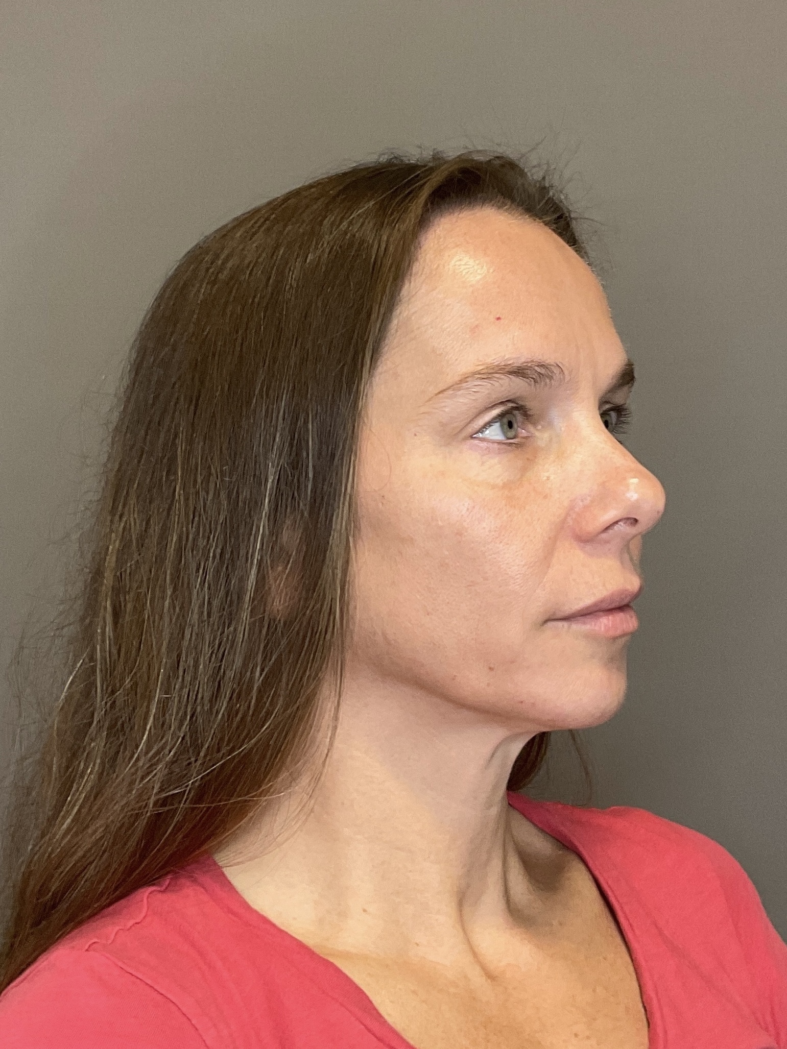 Sculptra Before & After Gallery - Patient 143308 - Image 3