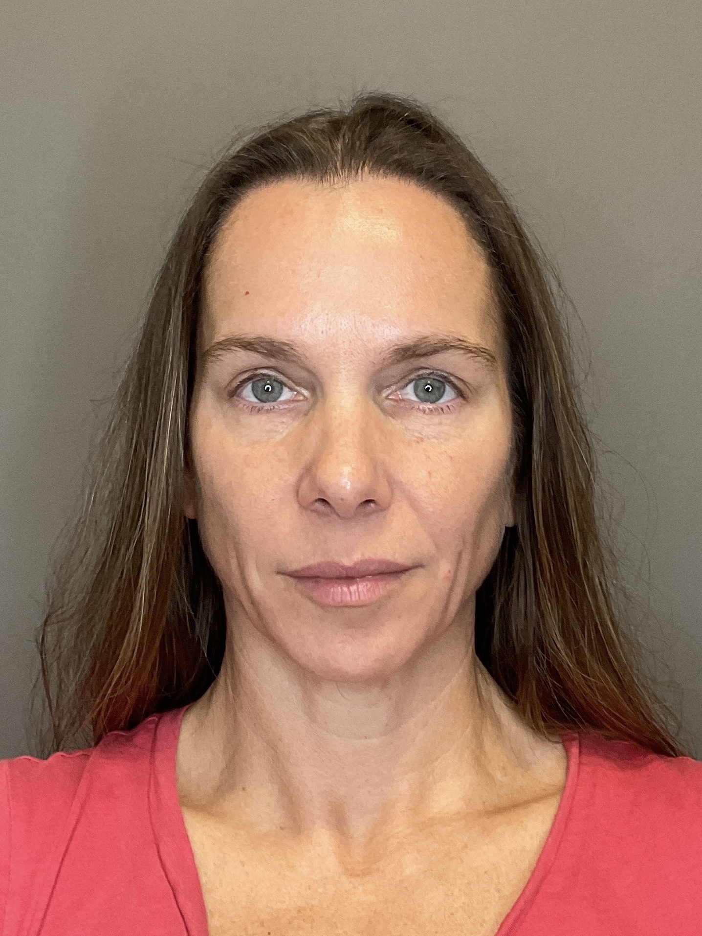 Sculptra Before & After Gallery - Patient 143308 - Image 1