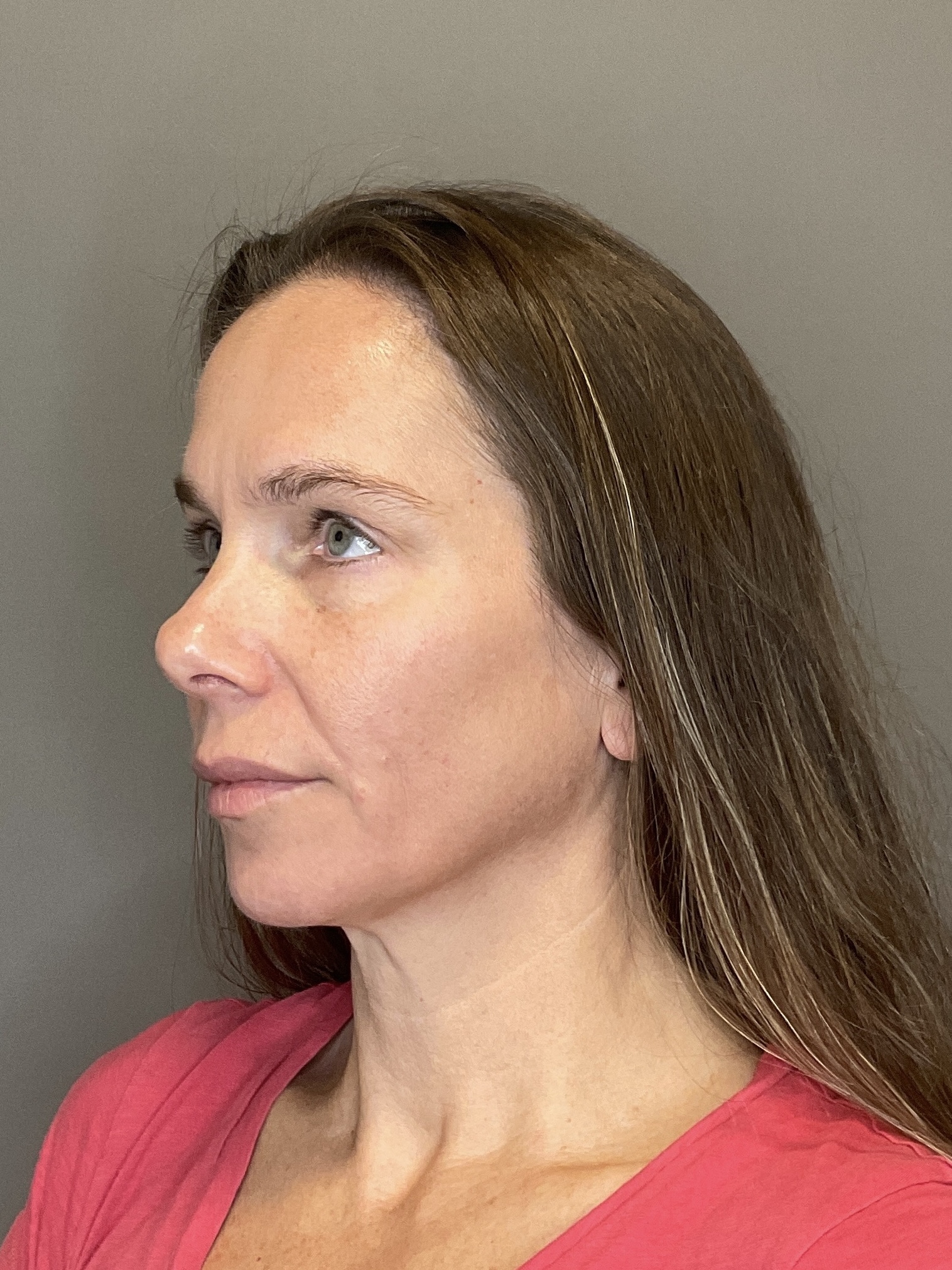 Sculptra Before & After Gallery - Patient 143308 - Image 5