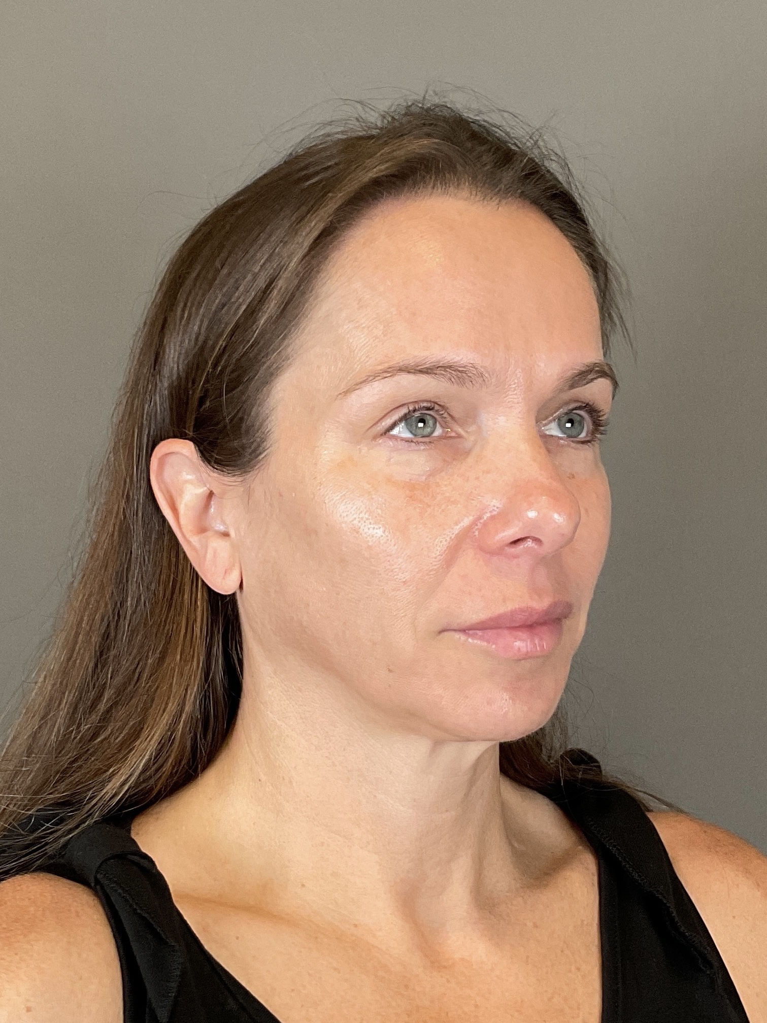 Sculptra Before & After Gallery - Patient 143308 - Image 4