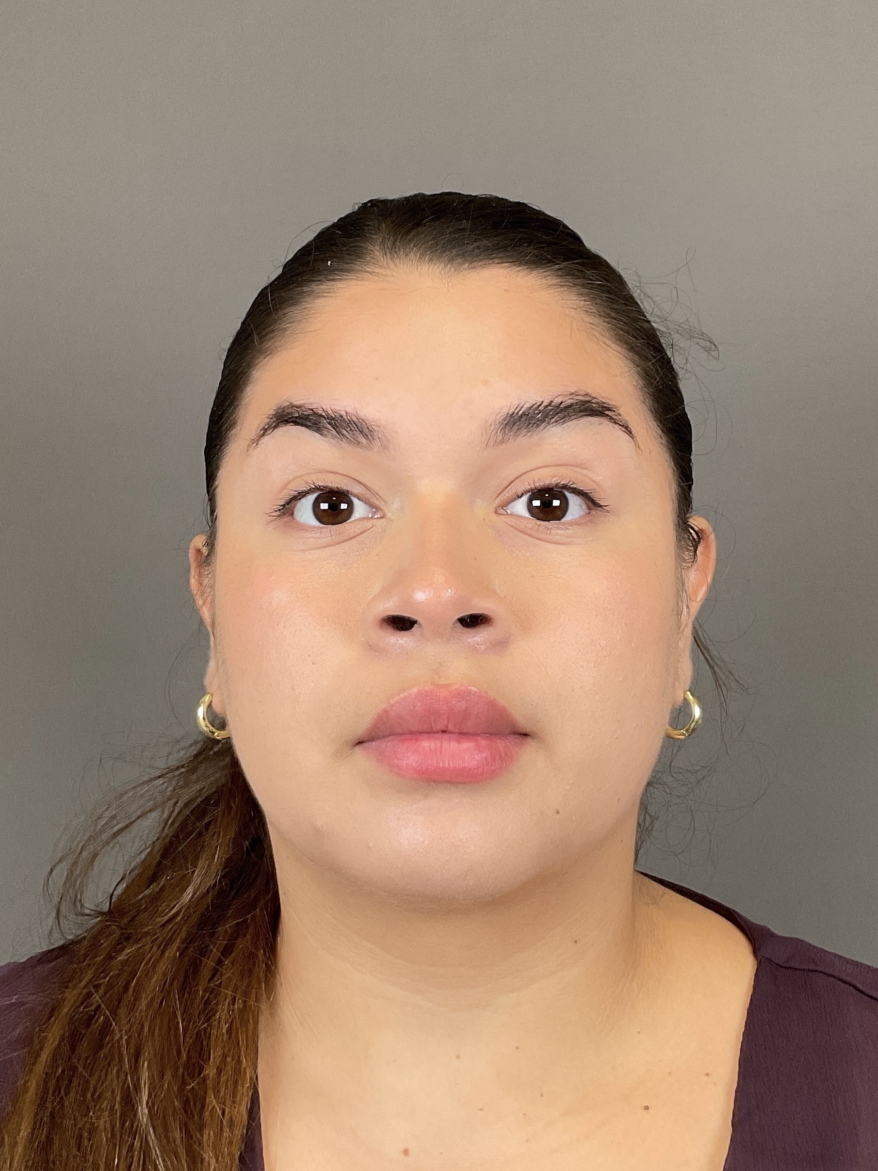 Neurotoxin Before & After Gallery - Patient 216731 - Image 6