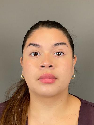 Neurotoxin Before & After Gallery - Patient 216731 - Image 6