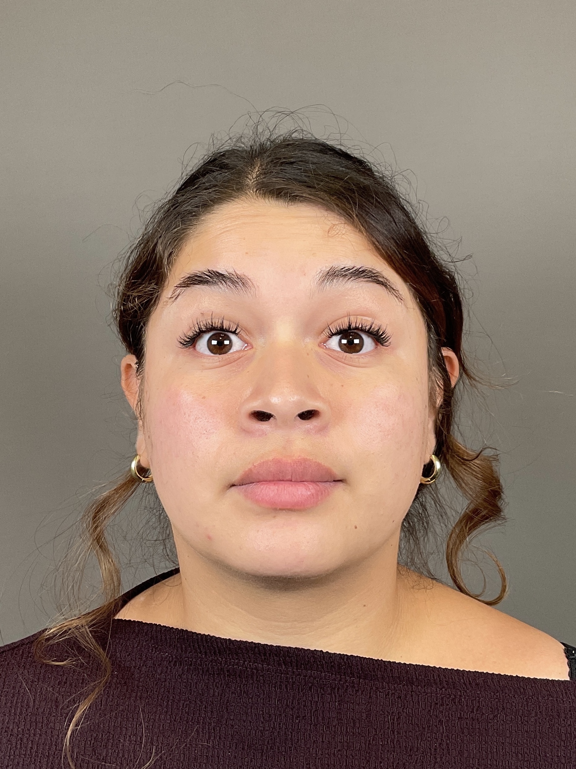 Neurotoxin Before & After Gallery - Patient 216731 - Image 5