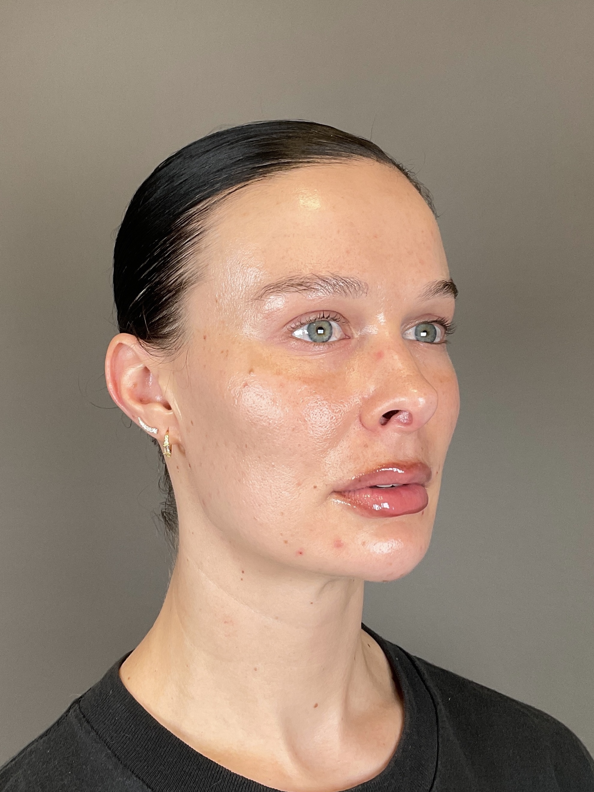Sculptra Before & After Gallery - Patient 150511 - Image 4