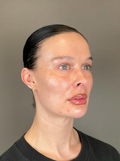 Sculptra Before & After Gallery - Patient 150511 - Image 4