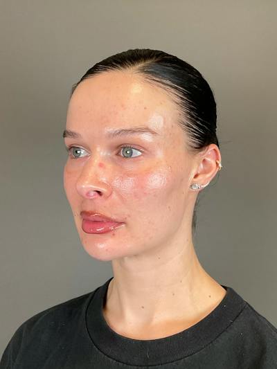 Sculptra Before & After Gallery - Patient 150511 - Image 6