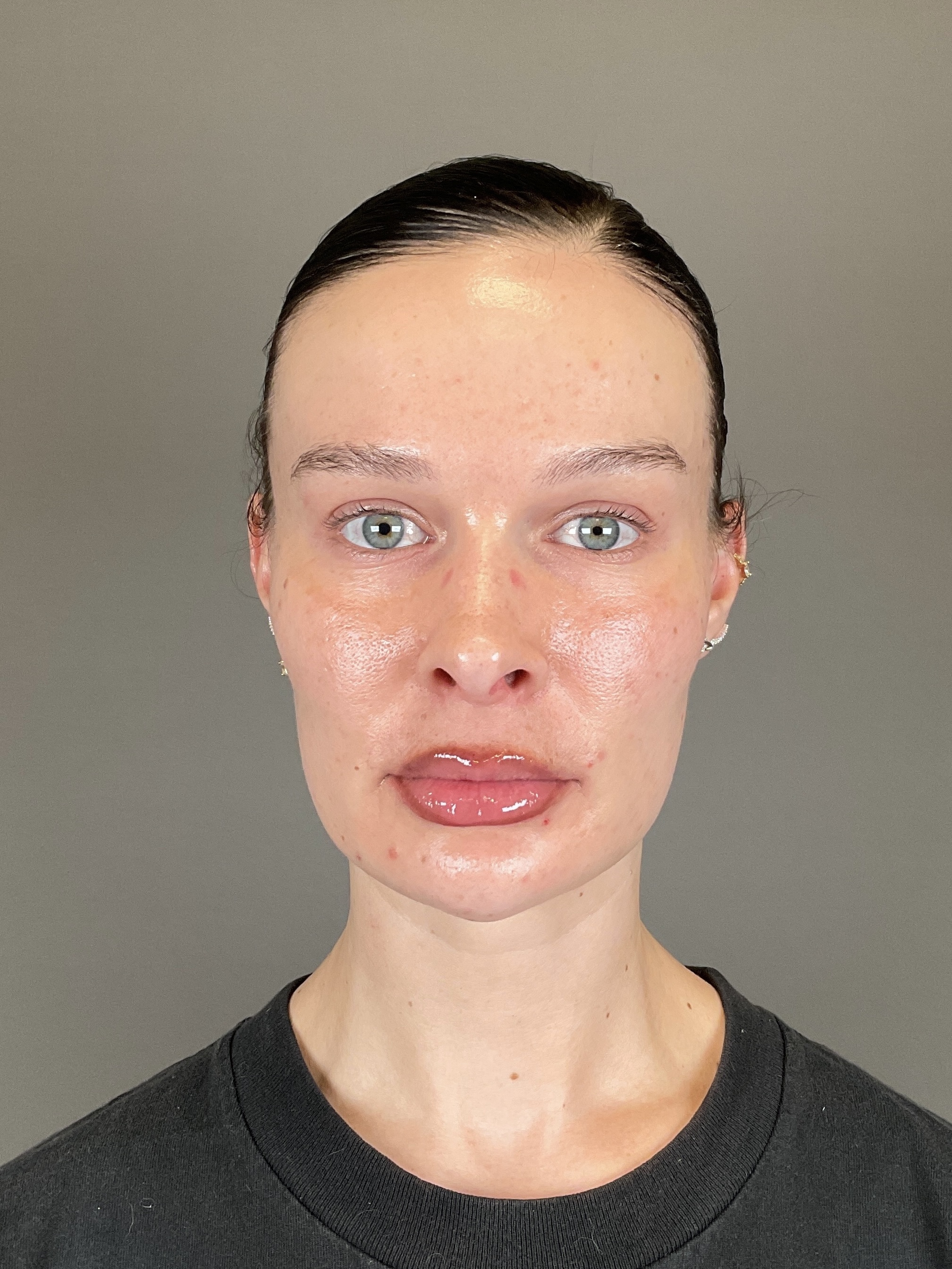 Sculptra Before & After Gallery - Patient 150511 - Image 2