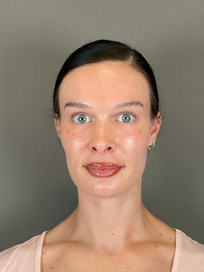 Sculptra Before & After Gallery - Patient 150511 - Image 1