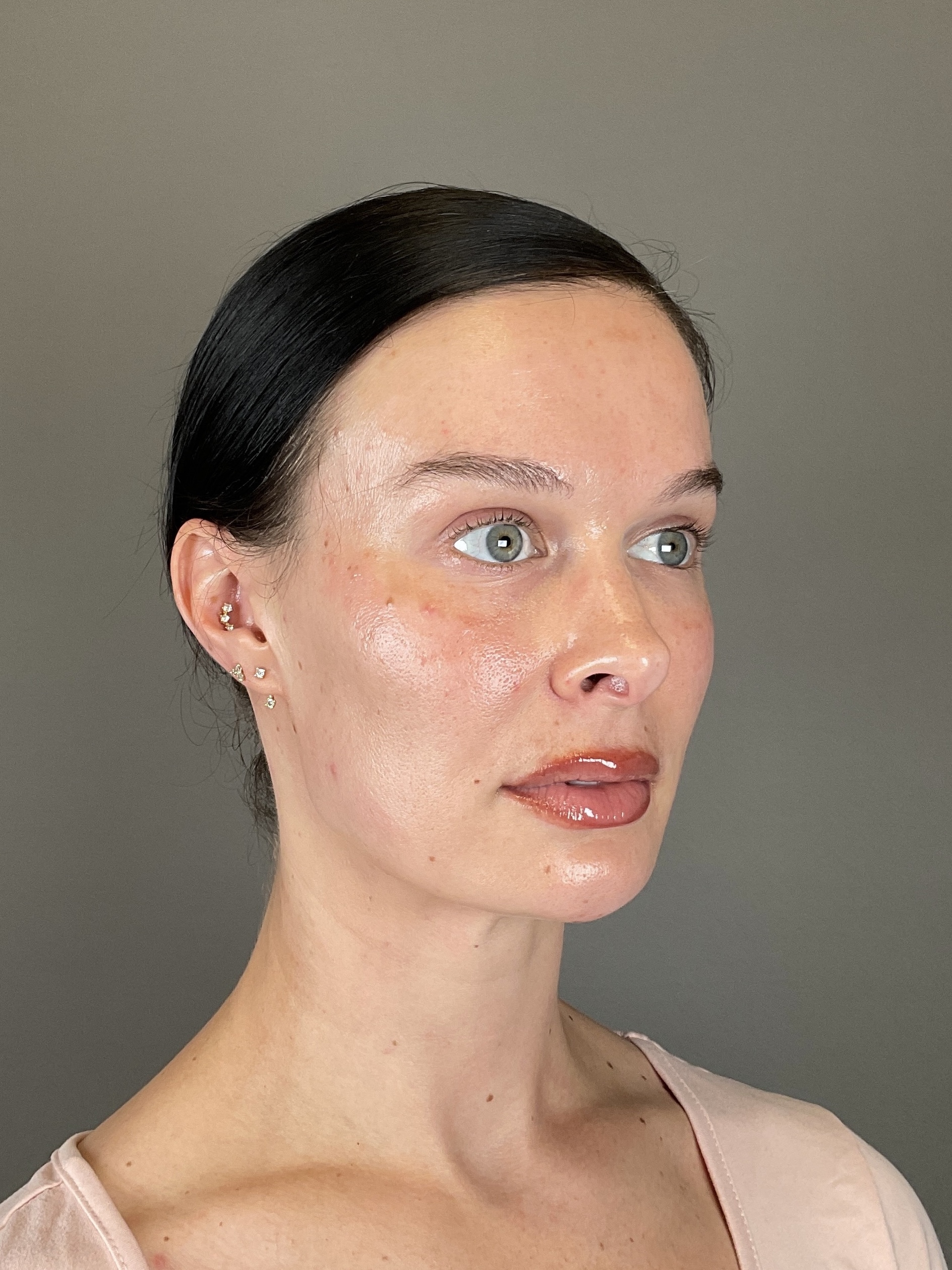 Sculptra Before & After Gallery - Patient 150511 - Image 3