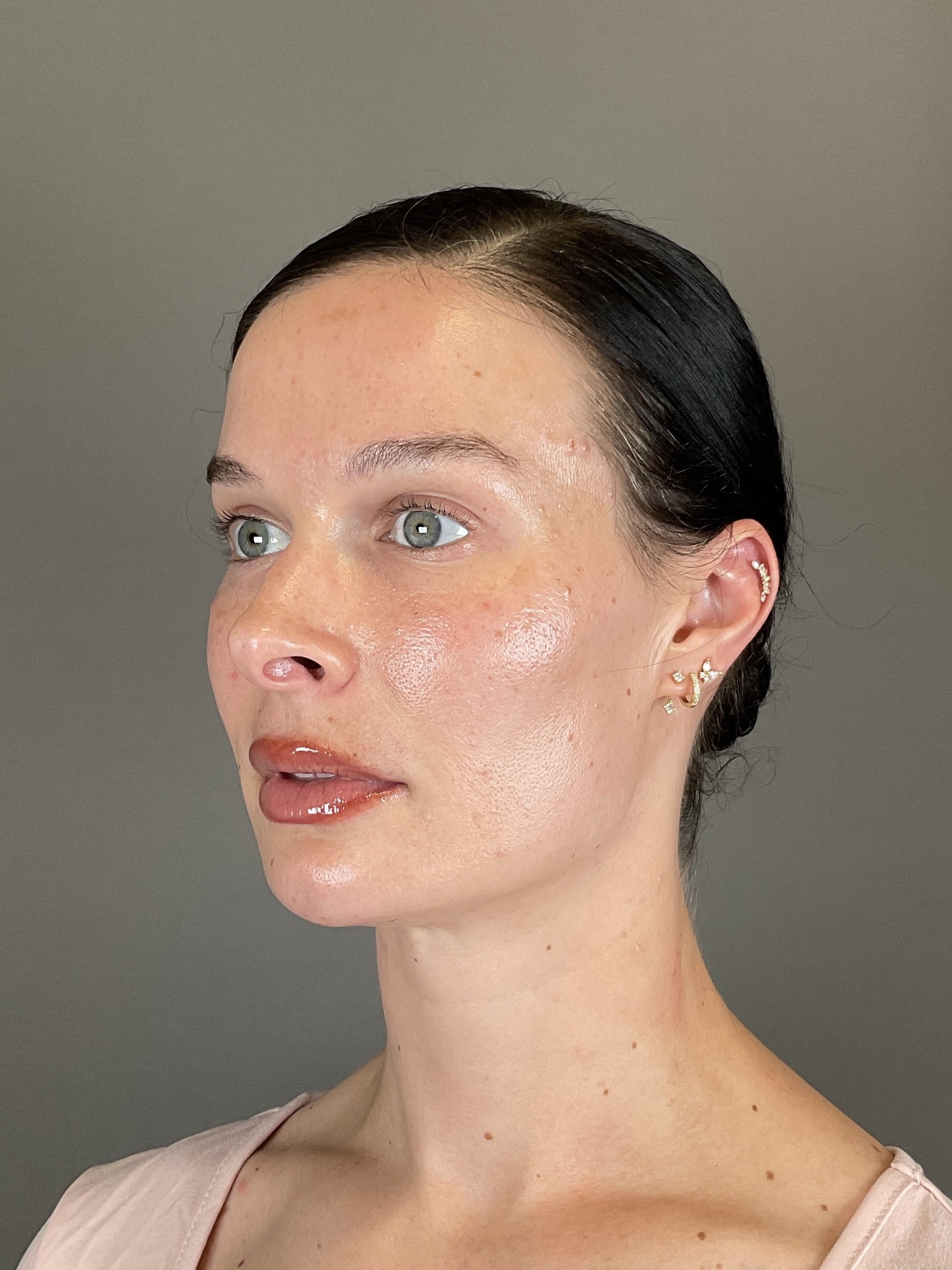 Sculptra Before & After Gallery - Patient 150511 - Image 5
