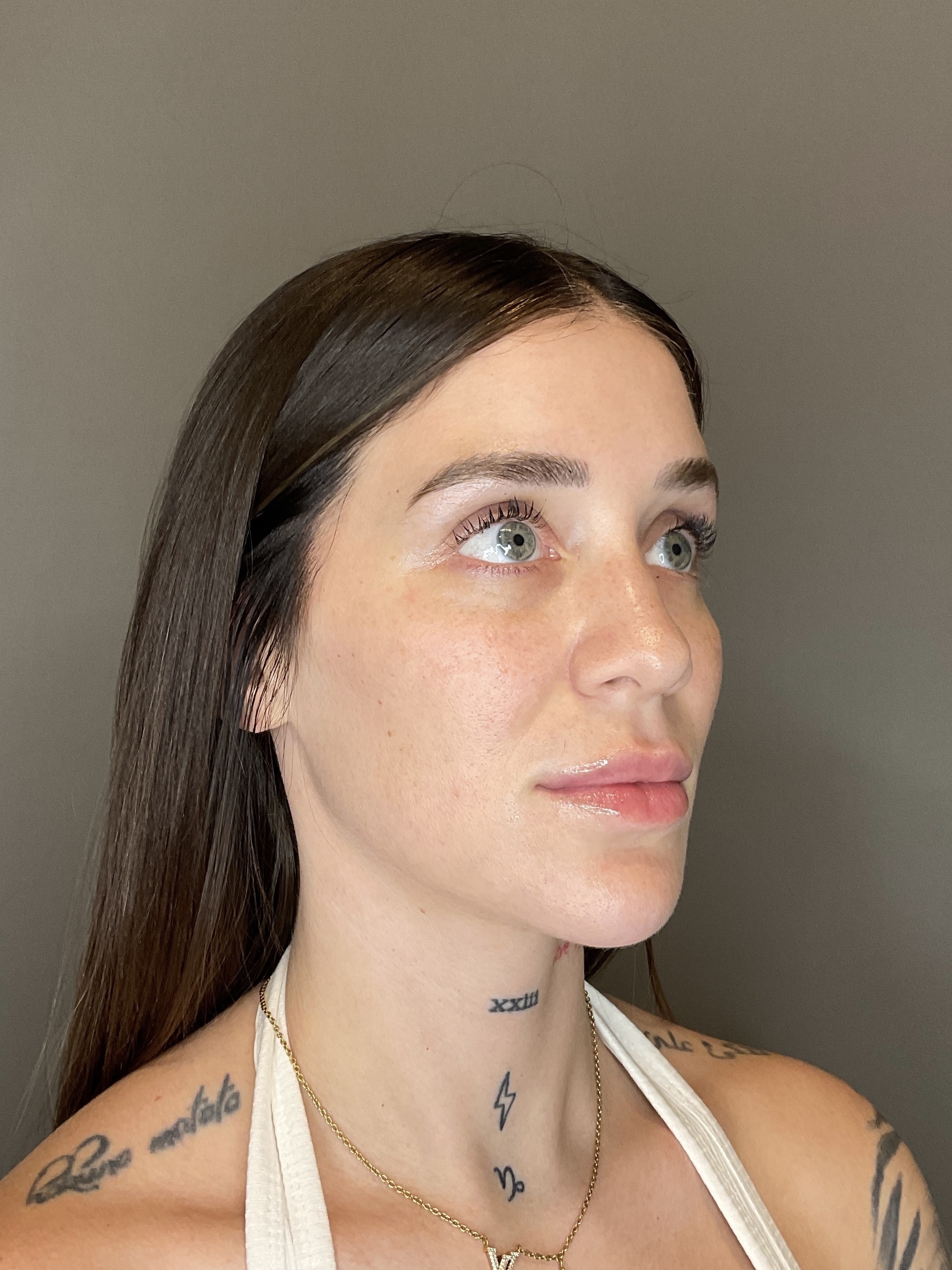 Hydrafacial Before & After Gallery - Patient 229724 - Image 3