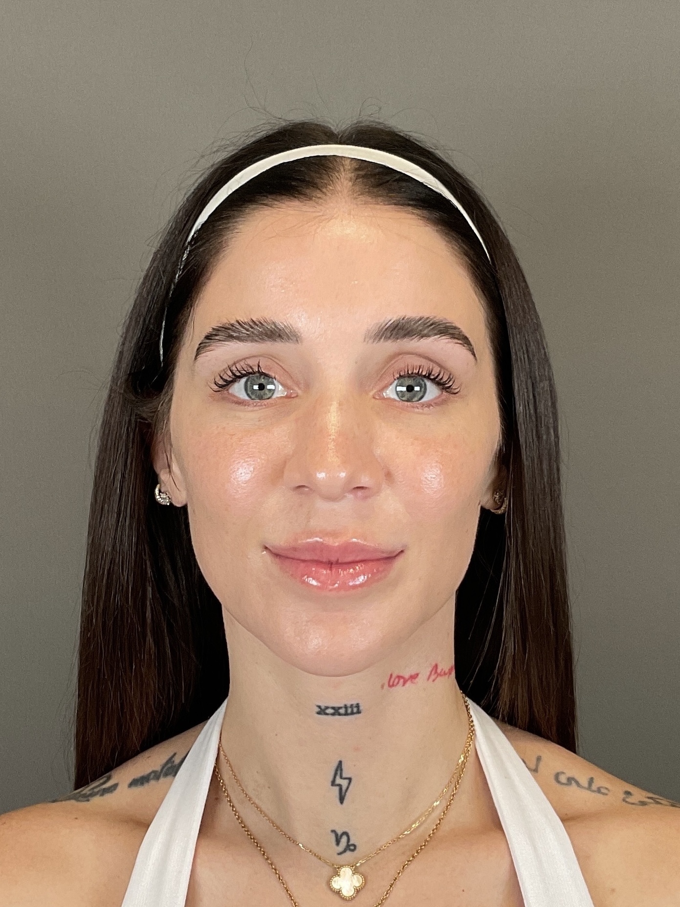 Hydrafacial Before & After Gallery - Patient 229724 - Image 2