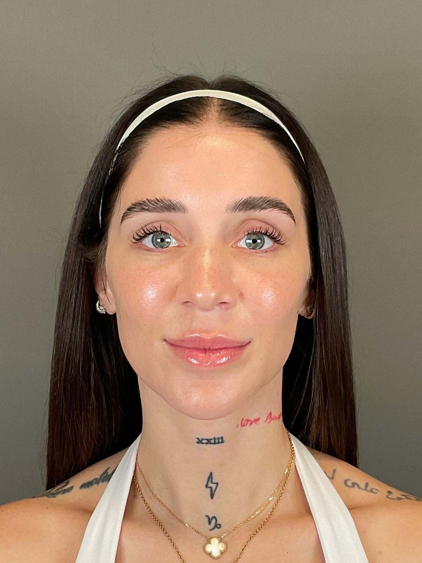 Hydrafacial Before & After Gallery - Patient 229724 - Image 2