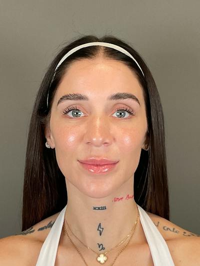Hydrafacial Before & After Gallery - Patient 229724 - Image 2