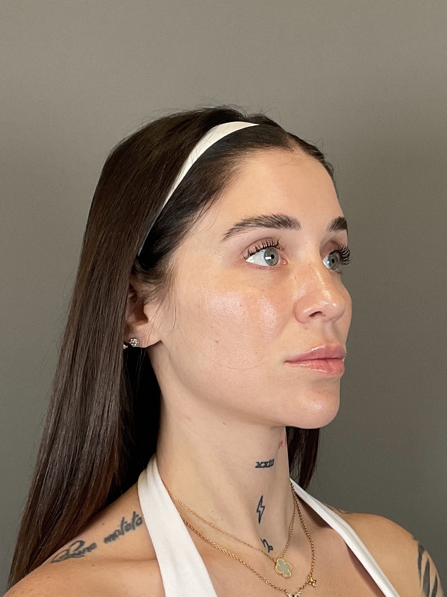 Hydrafacial Before & After Gallery - Patient 229724 - Image 4