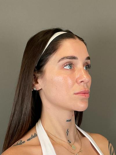 Hydrafacial Before & After Gallery - Patient 229724 - Image 4