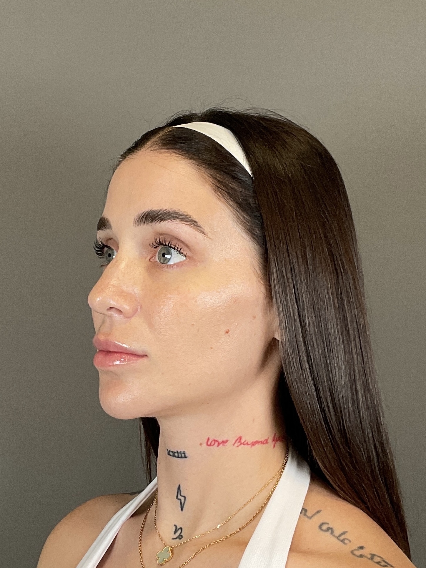 Hydrafacial Before & After Gallery - Patient 229724 - Image 6