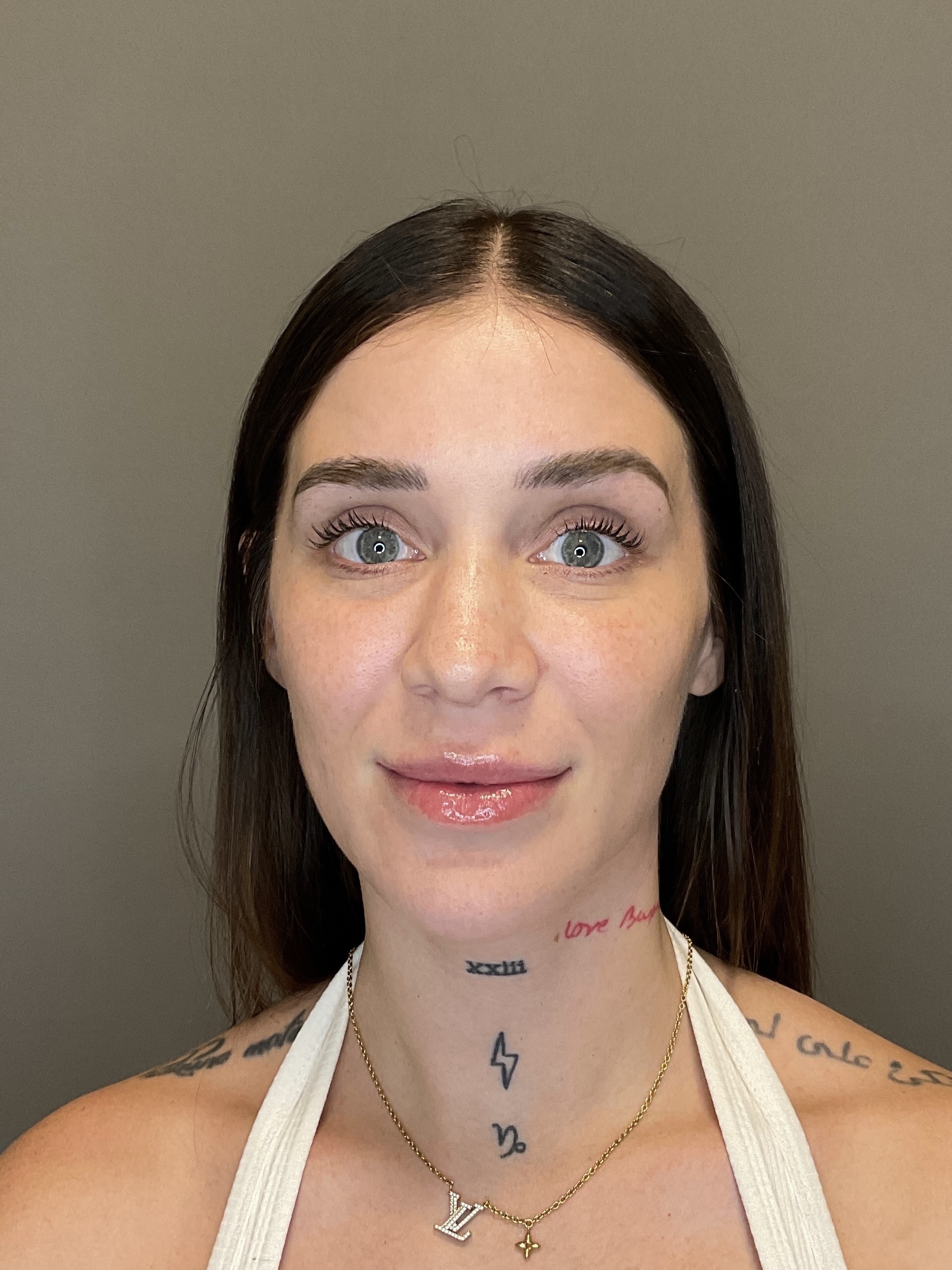 Hydrafacial Before & After Gallery - Patient 229724 - Image 1