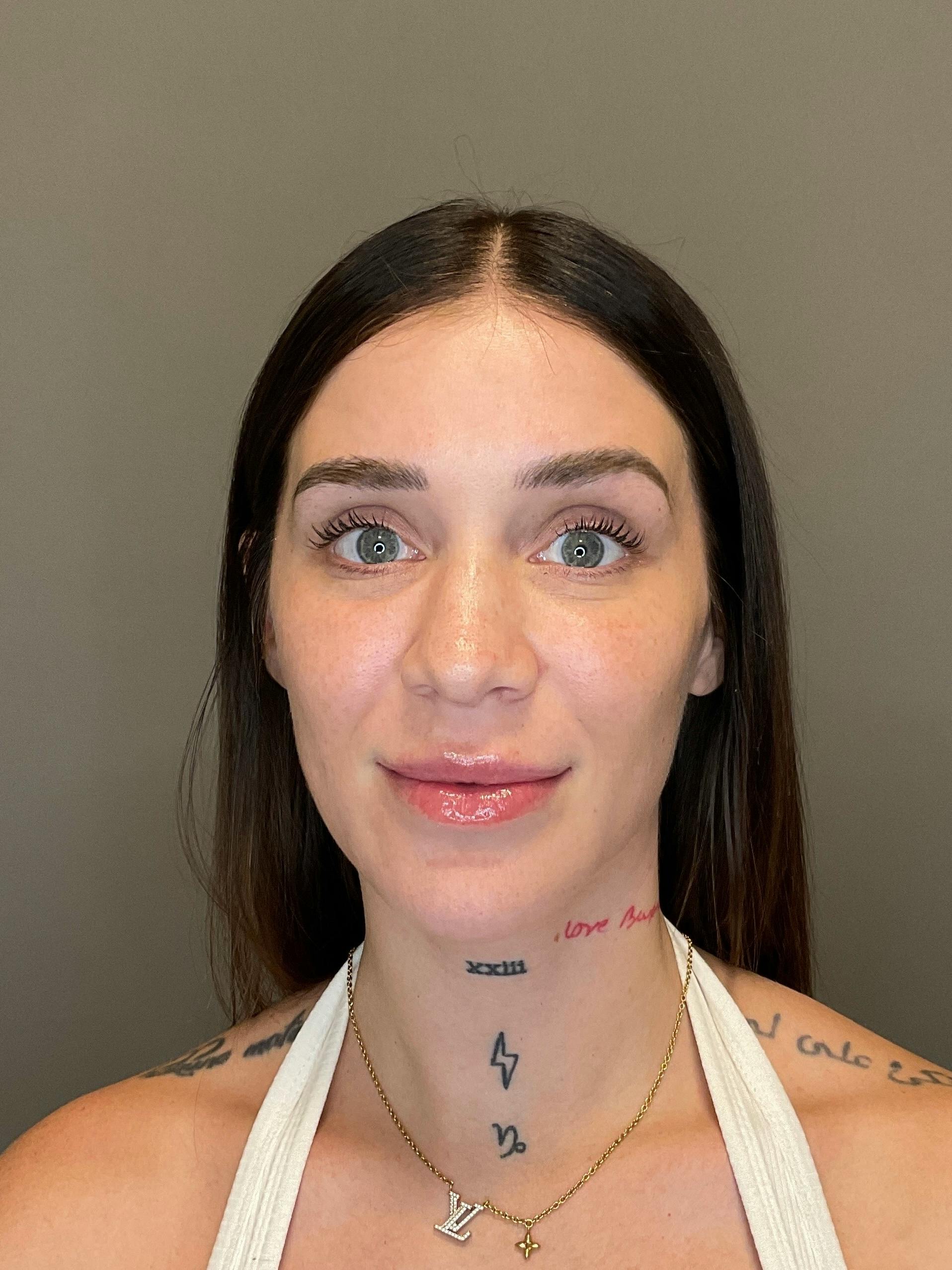Hydrafacial Before & After Gallery - Patient 229724 - Image 1