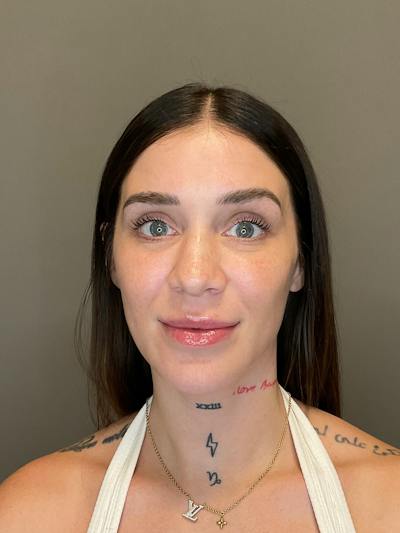 Hydrafacial Before & After Gallery - Patient 229724 - Image 1