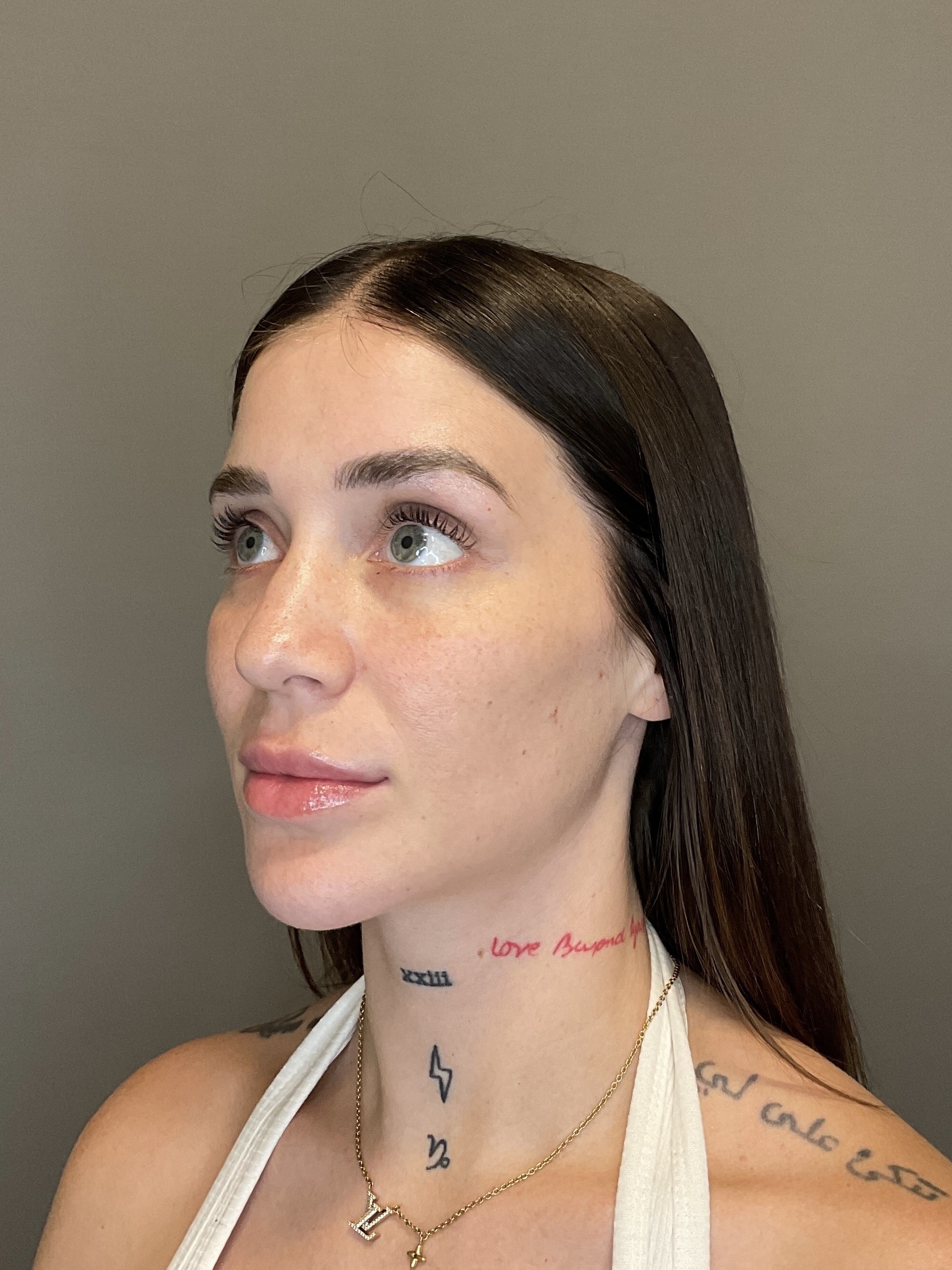Hydrafacial Before & After Gallery - Patient 229724 - Image 5