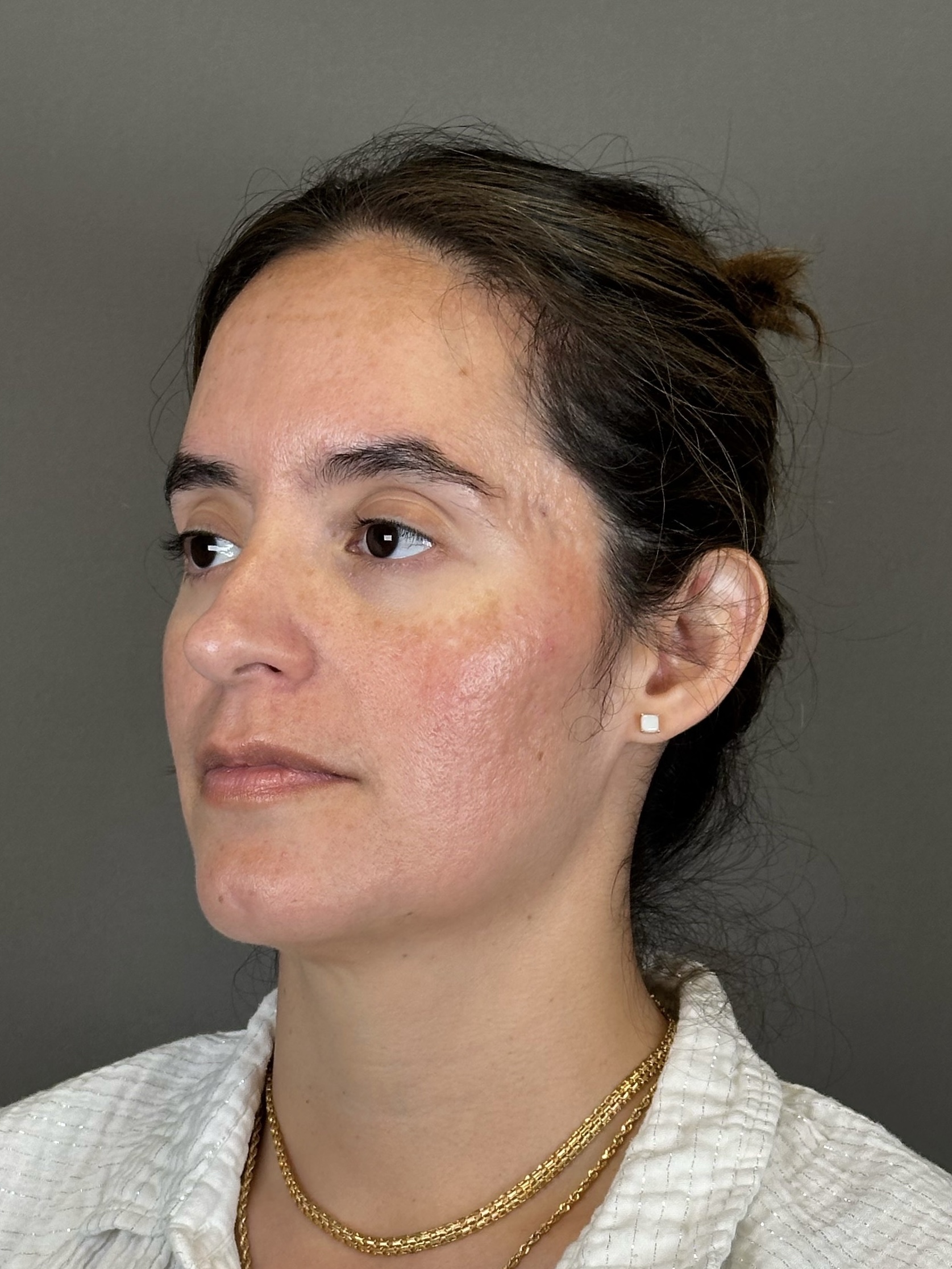 Microneedling with SkinPen Before & After Gallery - Patient 126847 - Image 6