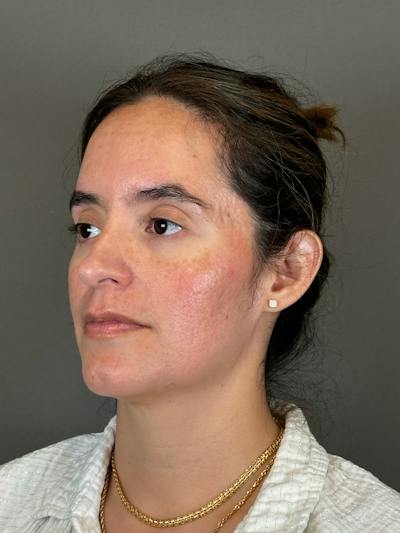 Microneedling with SkinPen Before & After Gallery - Patient 126847 - Image 6