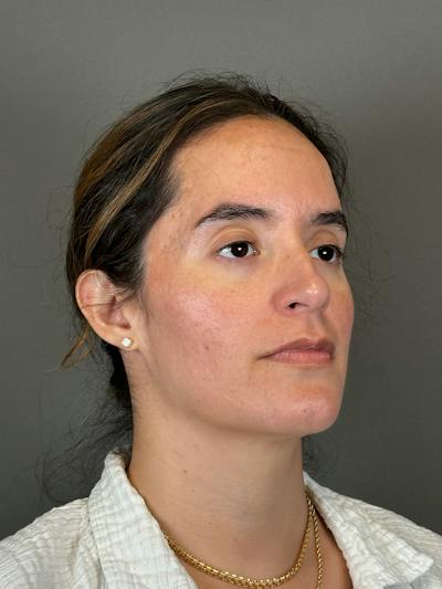 Microneedling with SkinPen Before & After Gallery - Patient 126847 - Image 4