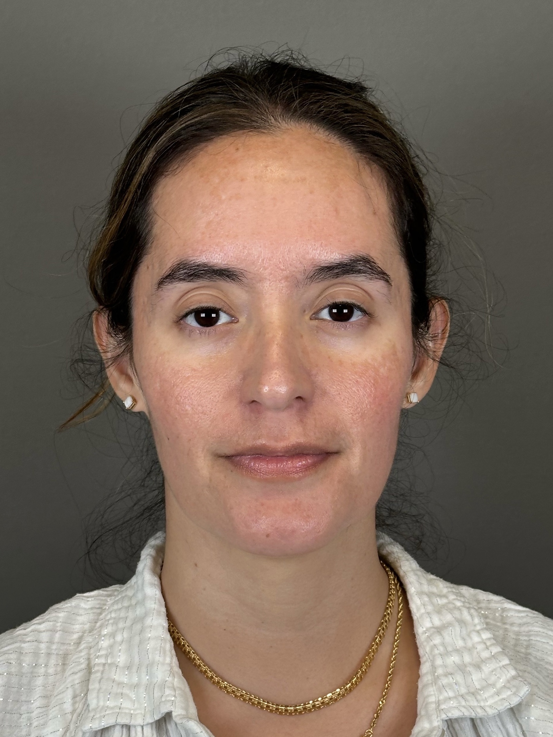 Microneedling with SkinPen Before & After Gallery - Patient 126847 - Image 2