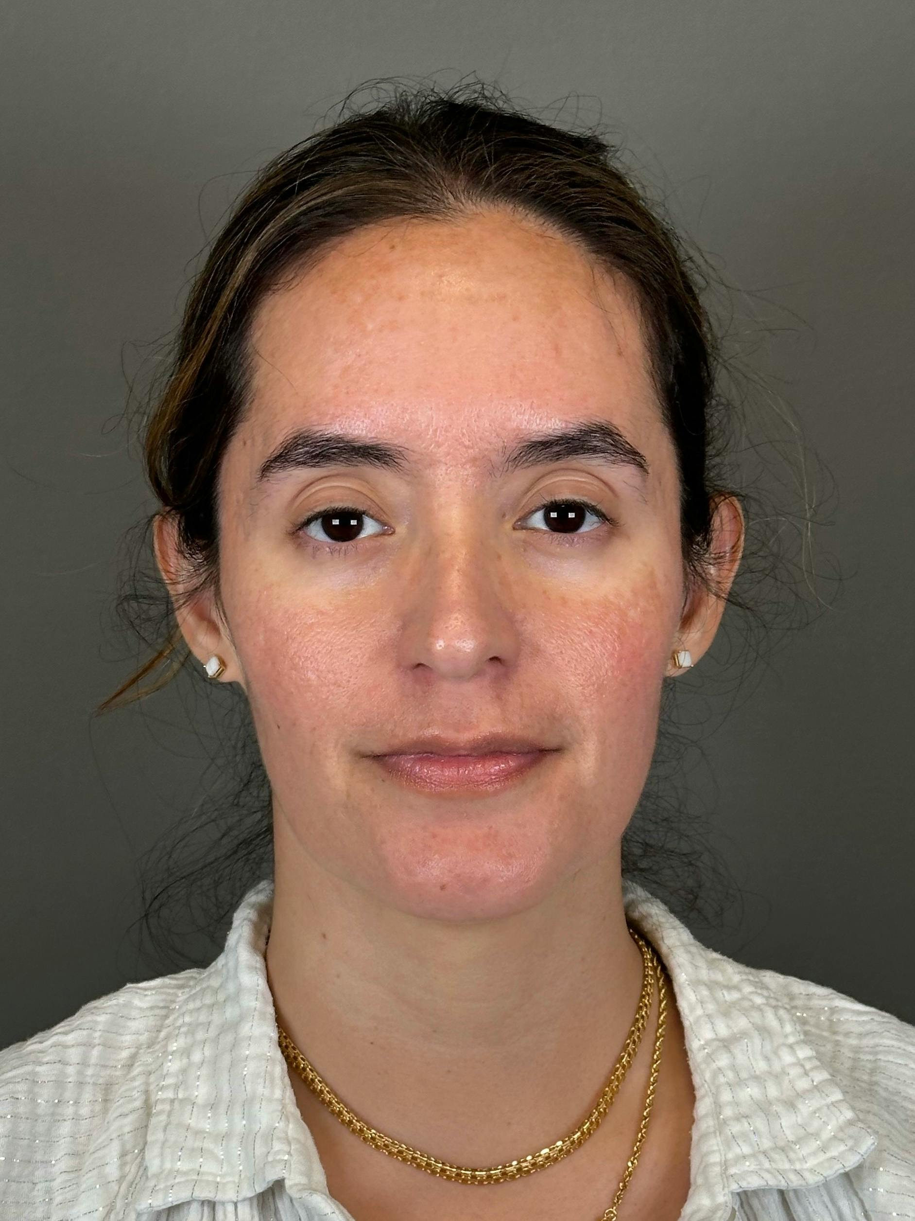 Microneedling with SkinPen Before & After Gallery - Patient 126847 - Image 2