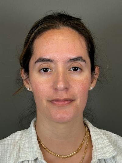 Microneedling with SkinPen Before & After Gallery - Patient 126847 - Image 2